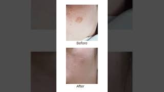 Leo - ALT VS Pigmentation