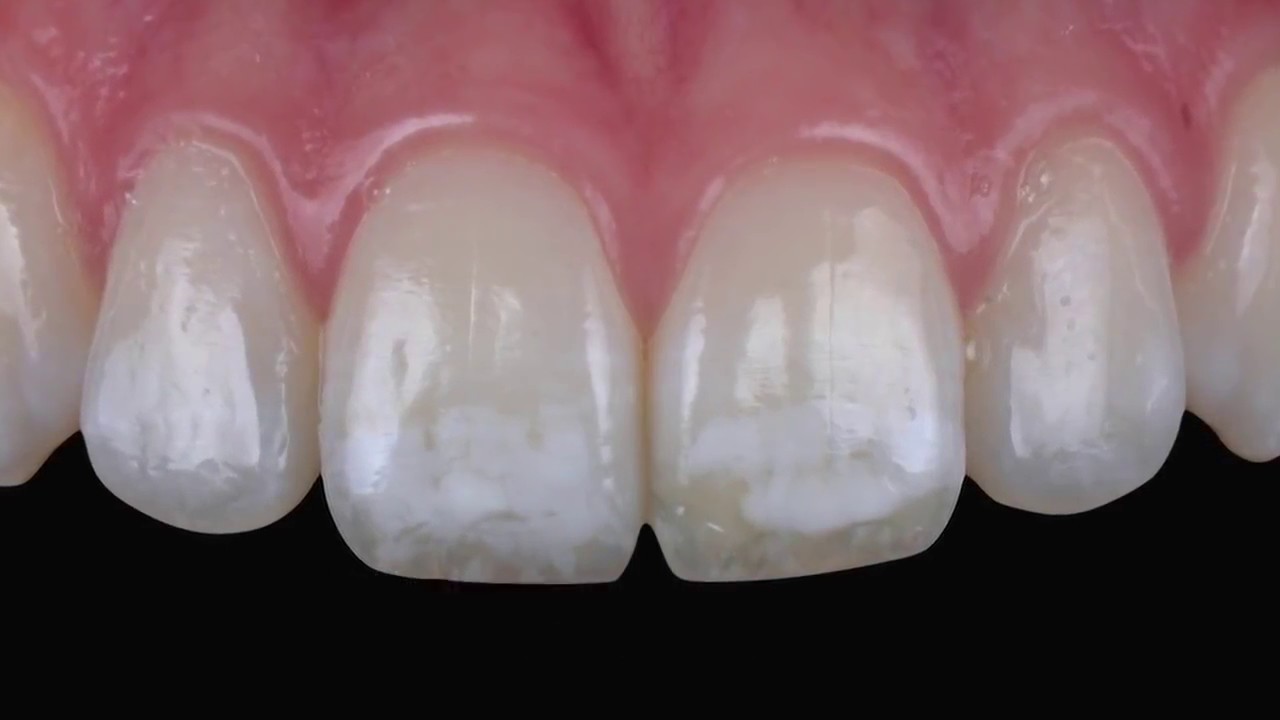 Tratamiento de la fluorosis mediante infiltración ICON YouTube