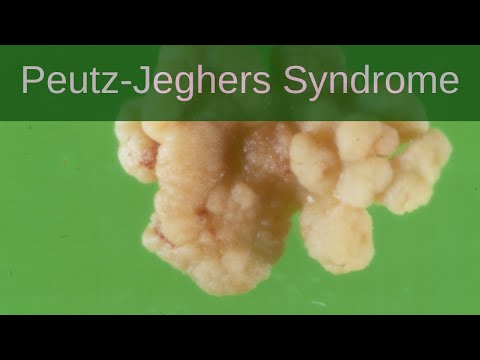 Peutz-Jeghers Syndrome - Pathology mini tutorial