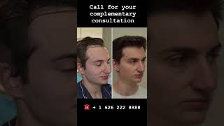 Before and After 6 months update on FUE Hair Transplant  in LA.  #fue #duet #fuehairrestoration