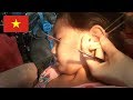 🇻🇳耳垢をピンセットで取りだす耳かきをしてもらうベトナムのタムちゃん