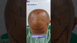 Hair Transplant Before & After | Cosmo Experts Clinic Gwalior #shorts