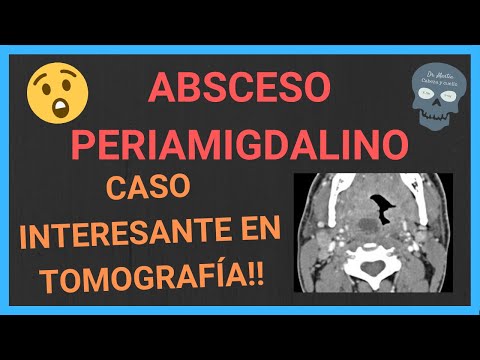 Vídeo: Absceso Para Amigdalar: Síntomas, Tratamiento, Autopsia, Diagnóstico