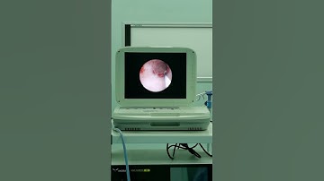 FHD Ureteroscopy Application - YKD 9003 Portable Endoscopic System