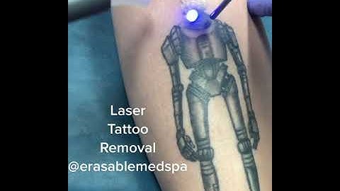 레이저로 타투 지우기 🔥