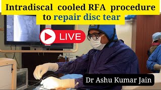 Intradiscal  cooled RFA  procedure to repair disc tear   Dr Ashu Kumar Jain