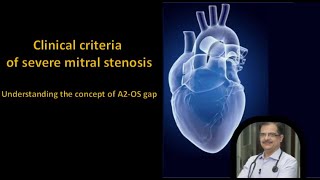 Clinical Criteria of Severe Mitral Stenosis: Understanding A2 Opening Snap Gap & Murmur Length
