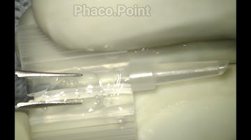 A simple trick of loading the IOL without encountering a trapped Haptic