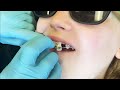 NEW TOOTH NEW SMILE | Amazing Transformation from Dr. Moses