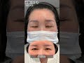 老化によって人相が悪くなることも??#前額リフト #額リフト #フェイスリフト