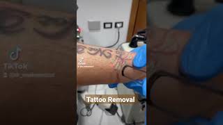 tattoo Removal #dermatologist #egypt #shorts #fractionalco2laser #tattoremoval #peeling