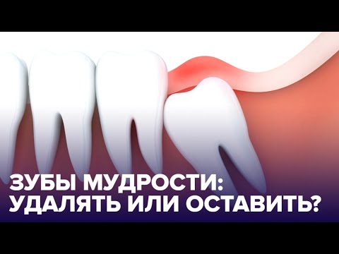 5 популярных мифов о ЗУБАХ МУДРОСТИ