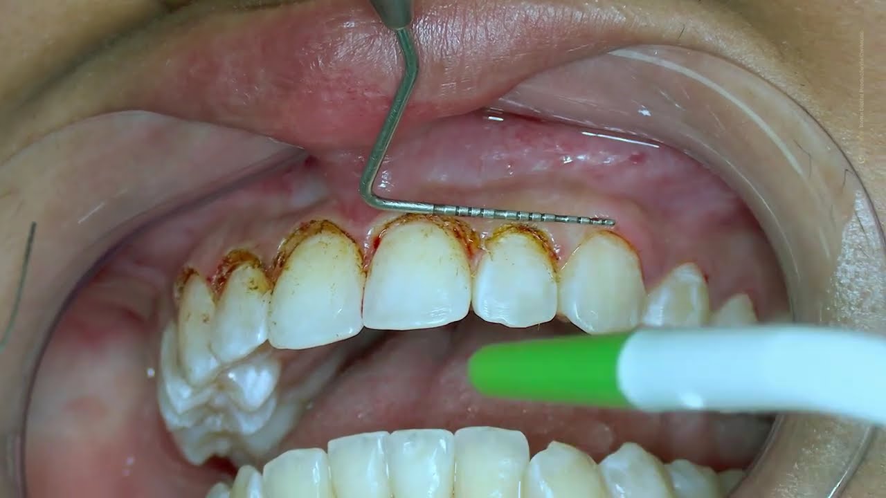 Assistir vídeo sobre Periodontia