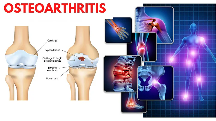 Osteoarthritis - causes, symptoms, diagnosis, treatment & pathology