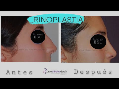 RINOPLASTIA/Dr. Xavier Sánchez García/ Cirugía de nariz/ Antes y despúes de la cirugía
