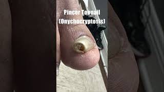 Pincer Toenail (Onychocryptosis)