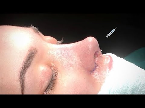 1x MAX Instant Barbie Doll Rhinoplasty Experimental