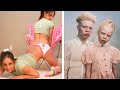 20 Most Unique Unusual Twins You Won&#39;t Believe Exist