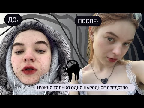 как я избавилась от прыщей