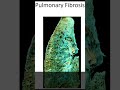 New IPF treatment in the works