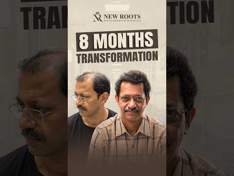 Grade 6 Baldness Treatment | Hair Transplant in Vashi | Navi Mumbai #hairtransplant #shorts