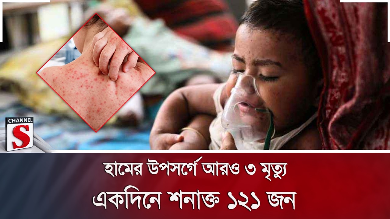হামের উপসর্গে আরও ৩ মৃ/ত্যু; একদিনে শনাক্ত ১২১ জন | Measles | Health | Channel S News