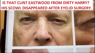 He Looked Like Clint Eastwood in Dirty Harry. The Scowl Disappeared after Blepharoplasty Surgery.