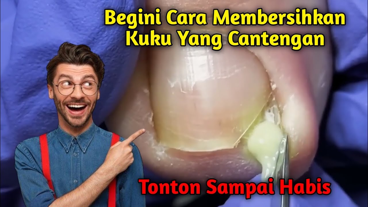 Begini cara mengatasi kuku kaki supaya terhindar dari Cantengan #part3