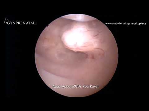 Video: Hyperplazie Endometria - Příznaky, Léčba, žlázová Hyperplazie Endometria