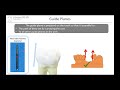 Rpd guide planes in 2 mins  rpd  removable partial denture online course