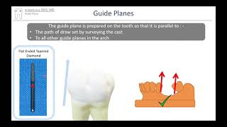 RPD Guide Planes in 2 mins - RPD ( Removable Partial Denture) online Course