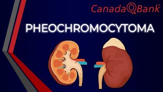 Pheochromocytoma