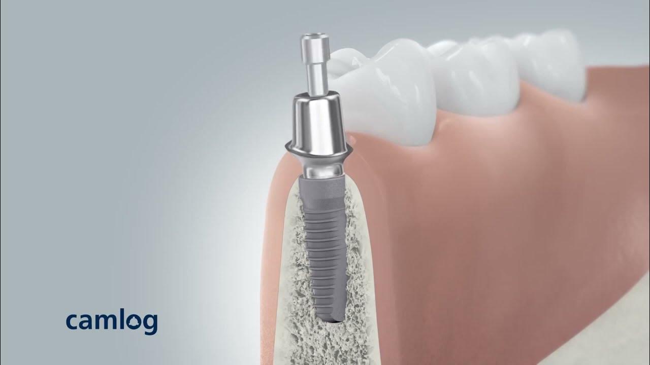 Couronne sur implant reconstruction d