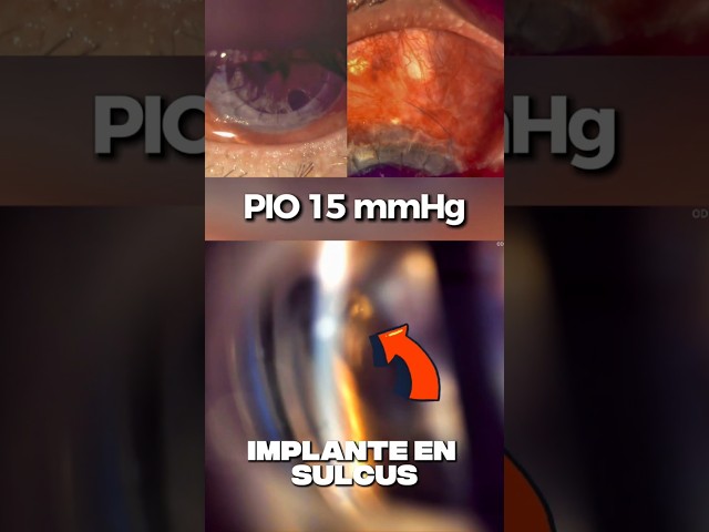 Implante PresserFlo a sulcus. #glaucoma #ophthalmology