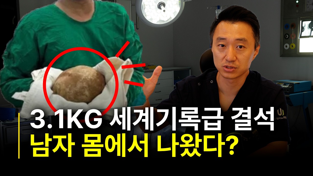 3.1kg 세계기록급 방광결석, 남자 몸에서 나왔다?