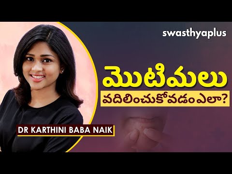 మొటిమలు- అంటే ఏంటి?, కారణాలు, చికిత్స | Dr Karthini Baba Naik on Acne in Telugu