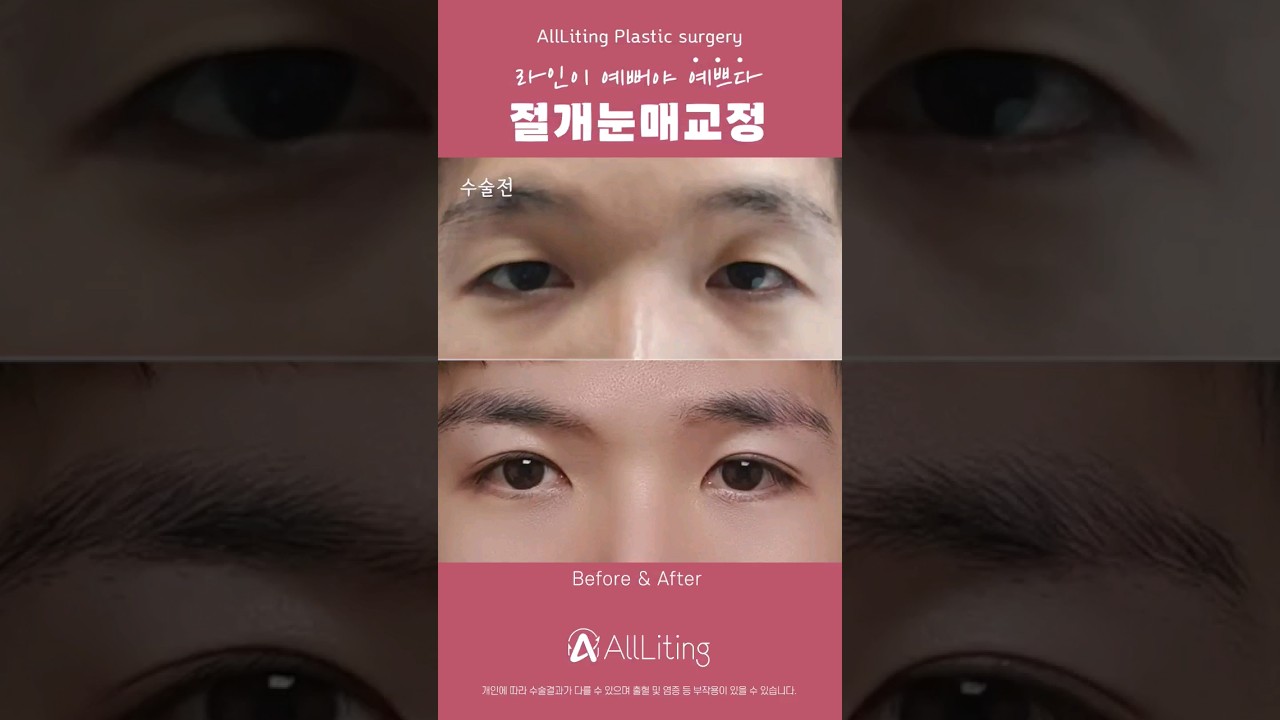 [Оллитинг Гоо Сайхны Мэс Заслын Эмнэлэг] #ЭрэгтэйНүднийМэсЗасал бүү эргэлз #Оллитинг-оос мэдэж авцгаая #НойрмогНүд #ЯдарсанНүд #ЗовхиныУнжилт #З