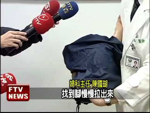 子宮破洞 胎兒腳卡住險命危－民視新聞