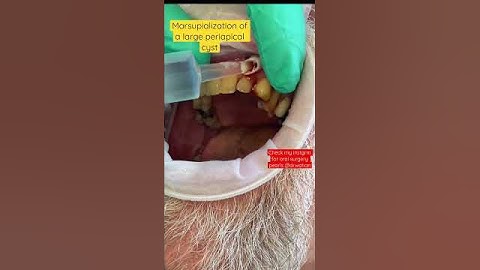 Marsupialization of a large radicular cyst