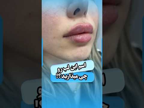 این لب با فاصله ۳ماه وهر بار یک سی سی تزریق شده تزریق لب لب روسی لب طبیعی دکتر نوید موسوی