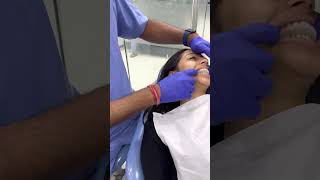 Download Lagu TMJ #splint to relive #pain in patients with chronic Jaw joint pain #TMJ #jointpain #clenching MP3