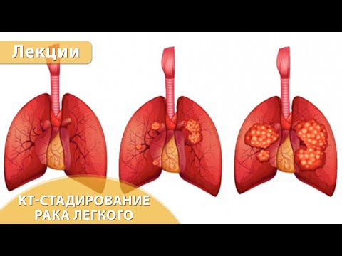 Часть 3. КТ стадирование рака легкого по критериям TNM8. Андрей Мангов