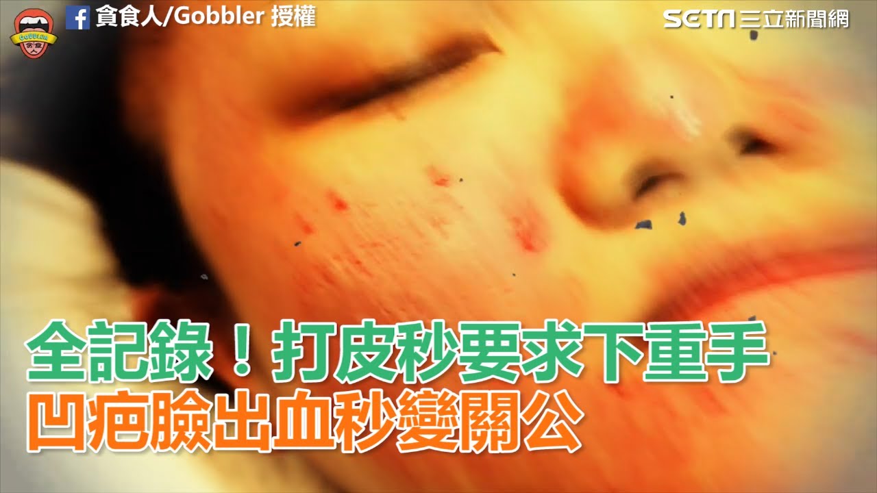 皮膚科醫師老實說 皮秒雷射一定比傳統淨膚雷射好 你的美 我負責 非侵入式體雕隔空減脂抽脂手術探索皮秒雷射皮秒雷射毛孔凹疤魔方電波橘皮 電波產後電波拉皮音波拉皮魔滴隆乳魔滴motiva波力媚隆乳手術玻尿酸隆鼻公主玻尿酸