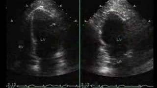 Inferior,Posterior and Lateral Myocardial Infarction