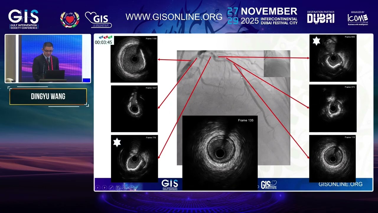 13 Case 3  Coronary Visual Intelligence System CorVIS Guided LM PCI Dingyu Wang