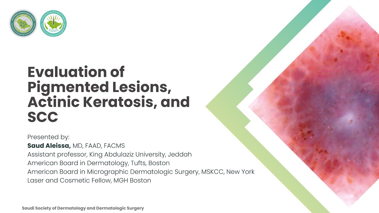 Lecture 14 | Evaluation of Pigmented Lesions, Actinic Keratosis, and SCC | Dr. Saud Aleissa