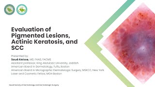 Lecture 14 | Evaluation of Pigmented Lesions, Actinic Keratosis, and SCC | Dr. Saud Aleissa