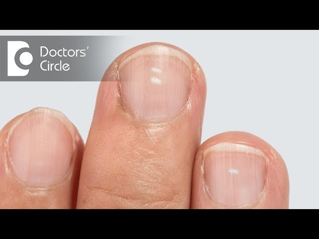 White spots on nails: Leukonychia causes, treatment and prevention