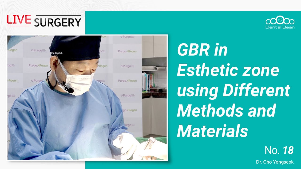 GBR in Esthetic zone using Different Methods and Materials [Live Surgery Dr. Cho Yongseok