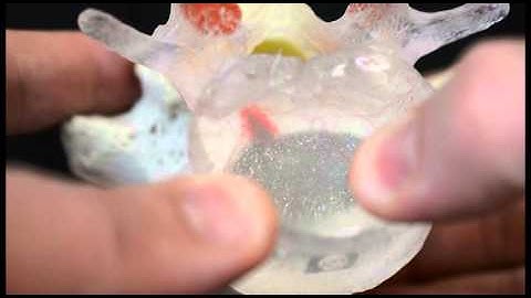 Hypermobility Lumbar Model by ddd - Dynamic Disc Designs